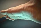 foot injury plantar fasciitis