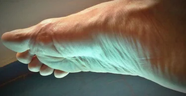 foot injury plantar fasciitis