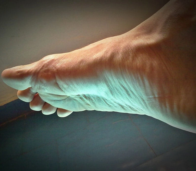 foot injury plantar fasciitis